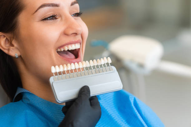 Why You Should Consider Getting Tooth Veneers?