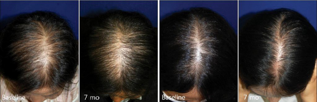 How to Reverse Thinning Hair After Menopause: An Expert Guide