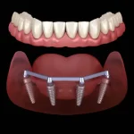 Innovative Techniques Redefining Dental Implant Success