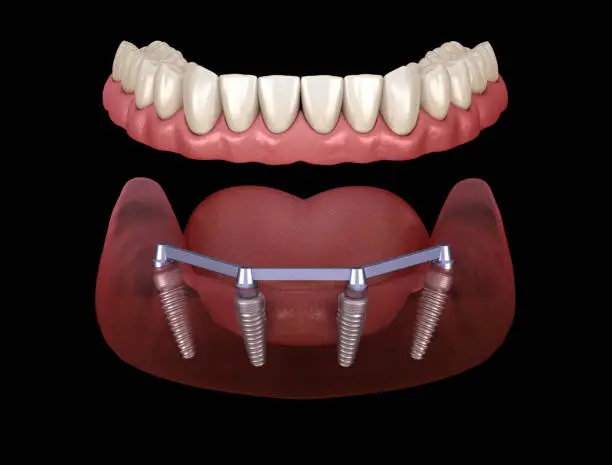 Innovative Techniques Redefining Dental Implant Success
